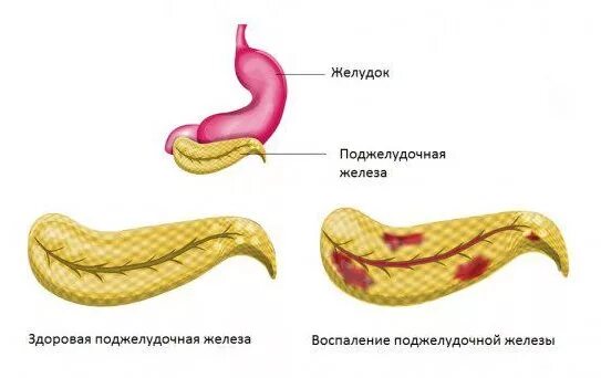 При воспалении поджелудочной железы. Здоровая поджелудочная. Панкреатит поджелудочной железы. Поджелудочная железа свиньи