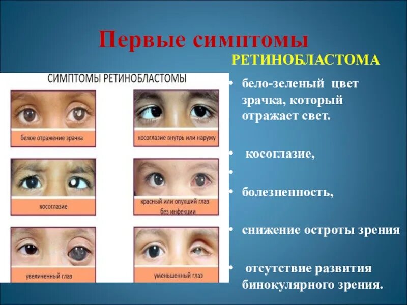 Ретинобластома 3 стадия. Ретинобластома 4 стадия. Симптомы ретинобластомы. Косоглазие симптомы