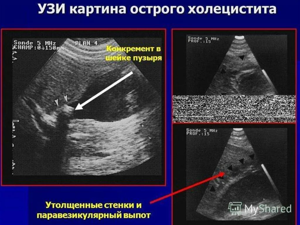 Диагноз калькулезный холецистит. Острый калькулезный холецистит на УЗИ. ЖКБ острый калькулезный холецистит УЗИ. УЗИ желчного пузыря калькулезный холецистит. УЗИ желчного пузыря при холецистите.