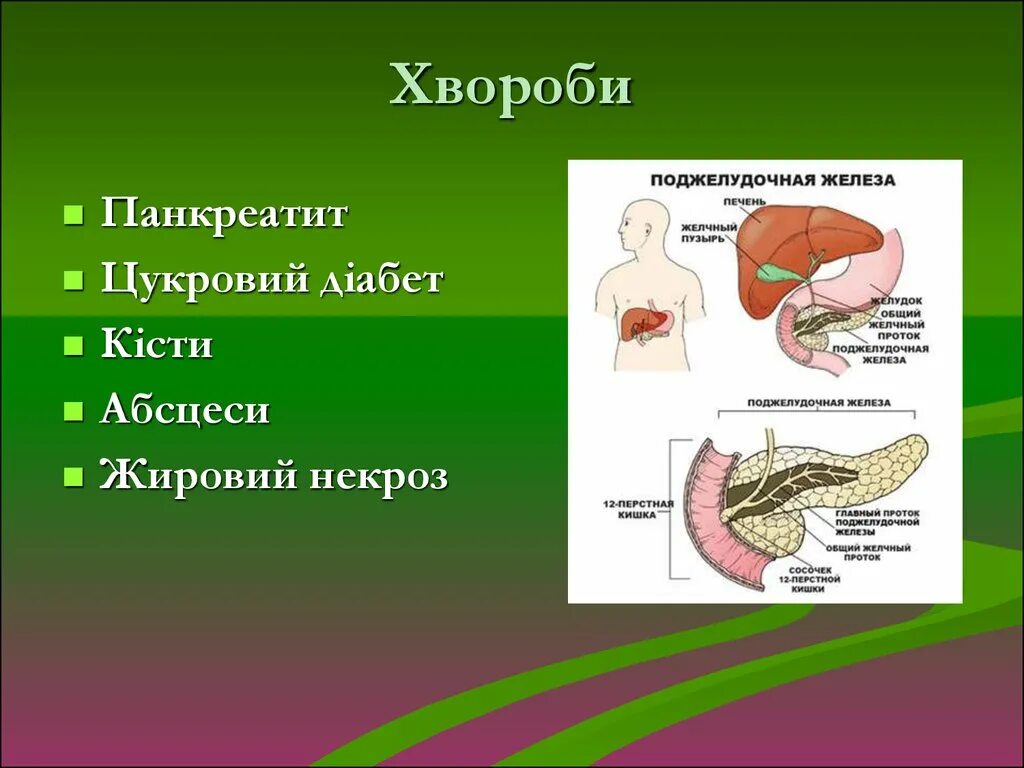 Что такое некроз поджелудочной железы у мужчин. Некроз поджелудочной железы. Поджелудочная железа некро. Некроз протока поджелудочной железы. Некроз хвоста поджелудочной.