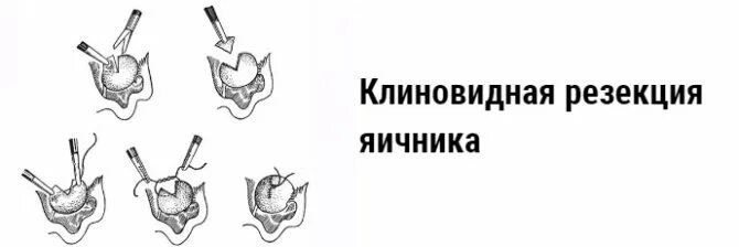 Препараты после удаления яичников. Клиновая резекция яичников. Кдиновиднаярезекцияяичниклв. Клиновиднаярецекцияяичников. Клиновидная резекция яичников лапароскопия.