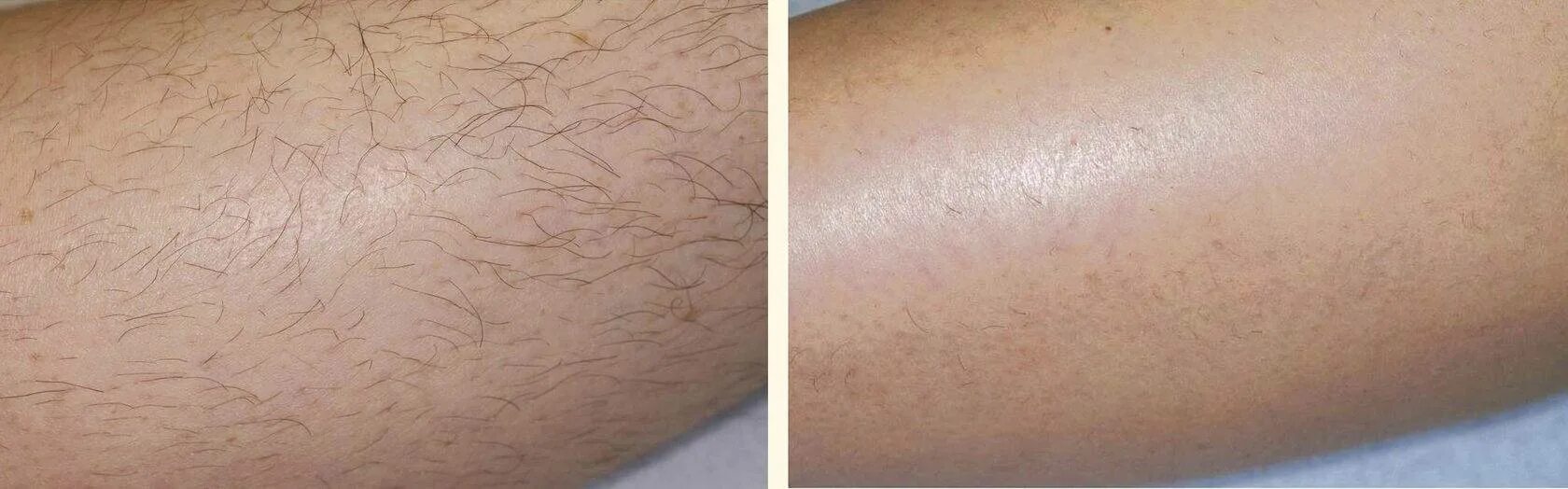 Почему у мужчин волосы на ногах. Лазерная эпиляция до и после. Лазерная эптляциядо и после.