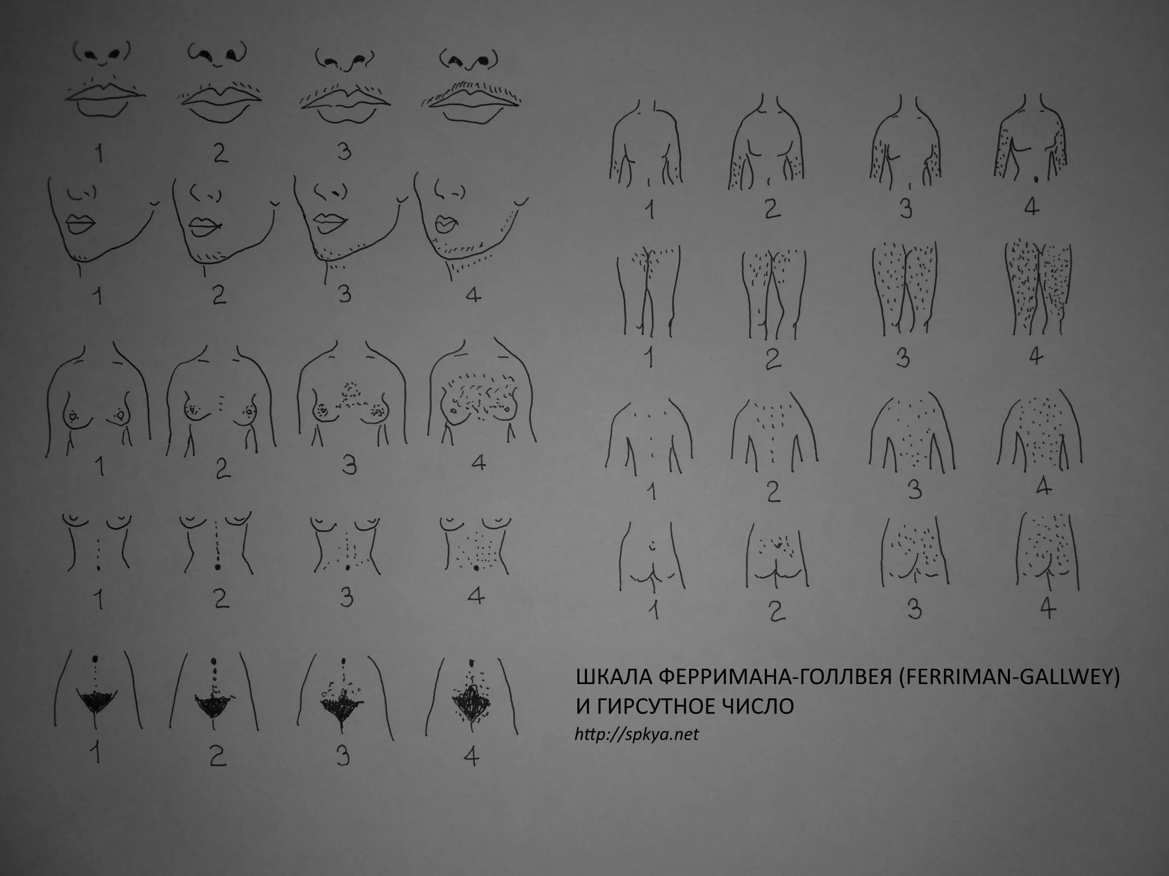 Формы мужского полового. Шкала Ферримана-Голлвея гирсутизм. Ферримана Голлвея. Таблица Ферримана Голлвея. Гирсутизм по шкале Ферримана.
