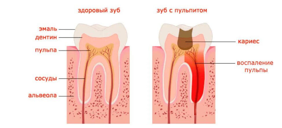 Зуб после простуды. Строение зуба кариес пульпит. Пульпит - воспаление пульпы зуба.