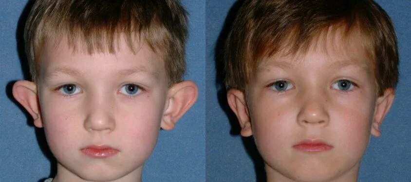 Паулина андреева уши. Операция на уши от лопоухости. Ушная раковина лопоухость. Прически при лопоухости женские. Лопоухость.