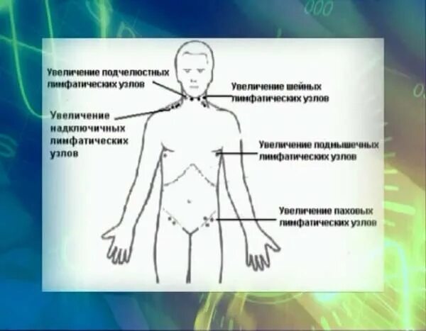 Лимфоузлы в паху у женщин причины. Где находятся лимфоузлы в паху. лимфоузлы на грудине у мужчин. паховые лимфатические узлы у женщин расположение.