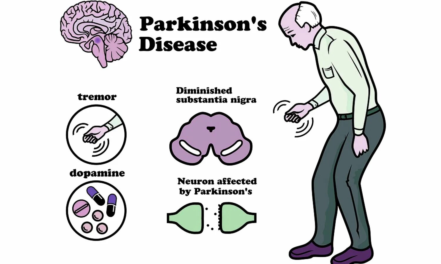 Синдром Паркинсона неврология. Клинические признаки болезни Паркинсона. Синдромы при болезни Паркинсона неврологические. Дофамин при болезни Паркинсона. Что такое болезнь паркинсона простыми словами симптомы