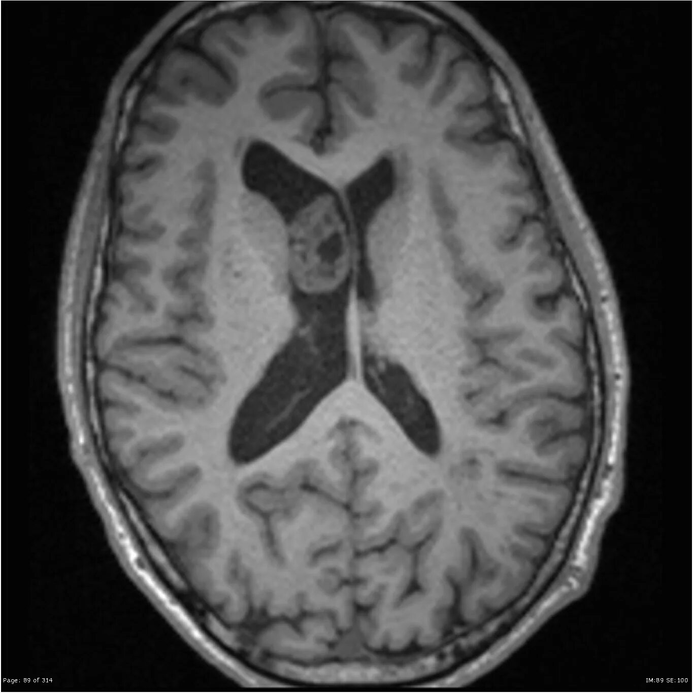 Дилатация бокового желудочка мозга. Асимметрия боковых желудочков мрт. Боковые желудочки головного мозга на мрт. Асимметрия боковых желудочков головного мозга на кт. Асимметрия желудочков головного мозга мрт.