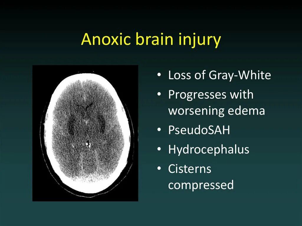 Brain injury. CT Brain.