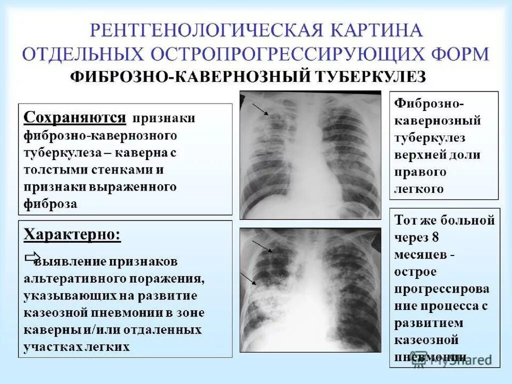 Рентген фиброзно кавернозного туберкулеза синдром. Каверна при туберкулезе на рентгене. Кавернозный туберкулез легких рентген. Фибринозно-кавернозный туберкулёз рентген.