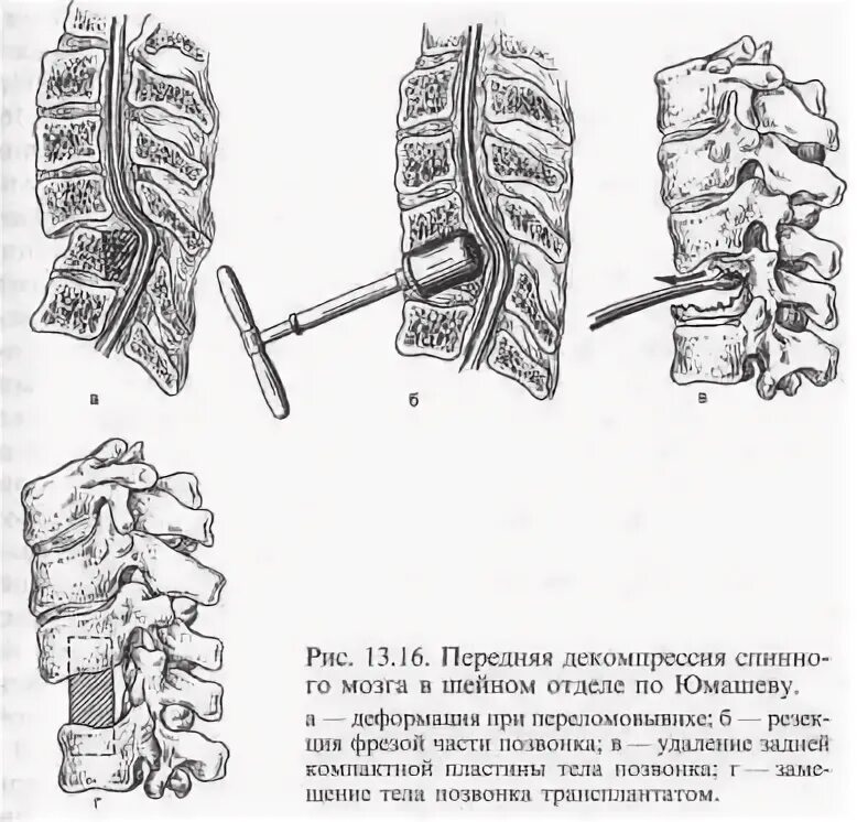 Декомпрессия позвонков. Декомпрессия позвоночника операция. Декомпрессия поясничного отдела позвоночника. Самостоятельная декомпрессия позвоночника.