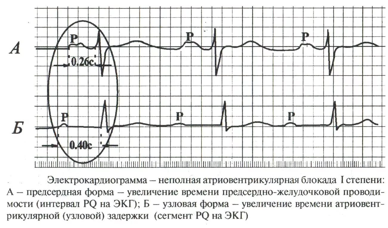 Полная атриовентрикулярная блокада. ЭКГ при атриовентрикулярных блокадах. Атриовентрикулярная блокада ЭКГ критерии. Неполная АВ блокада ЭКГ. ЭКГ признаки полной атриовентрикулярной блокады.