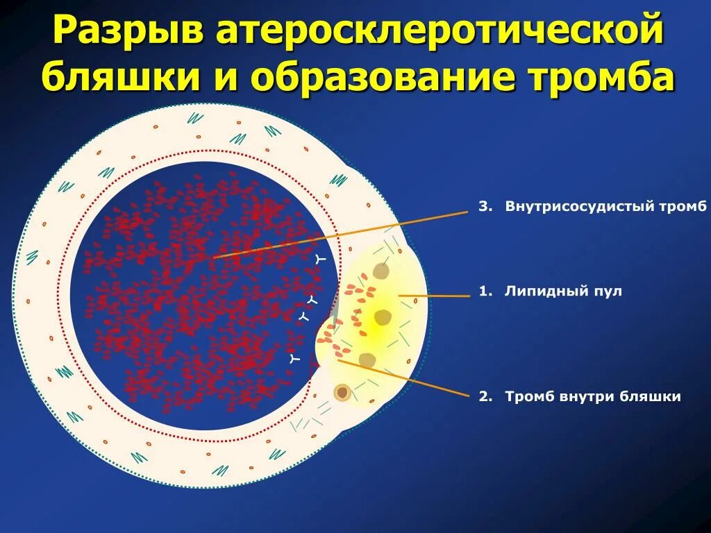 Разрыв атеросклеротической бляшки. Разрыв атеросклеротической бляшки патогенез. Образование атеросклеротической бляшки. Схема образования атеросклеротической бляшки. Тромб и бляшка разница