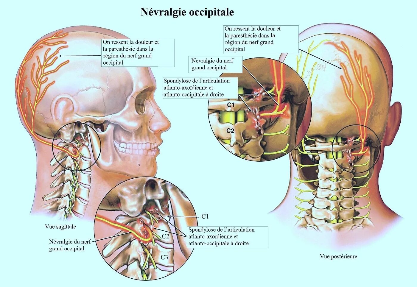 Neuralgia латынь. Atlanto occipital joints anatomy. синдром затылочного рога ( occipital horn syndrome) .. neuralgia narva екójdzielnego явоęcia.