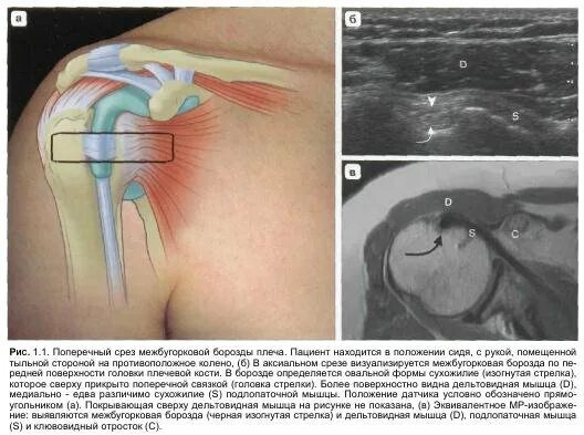 Тендинит сухожилия надостной. Тендопатия сухожилия надостной мышцы. Тендинит мышцы плечевого сустава. Ротаторная манжета плечевого сустава УЗИ.