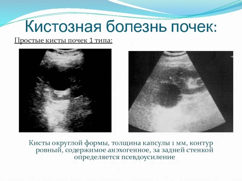 Признаки кистозных изменений. Киста почки анэхогенное. Округлое анэхогенное образование. Анэхогенное однородное содержимое.