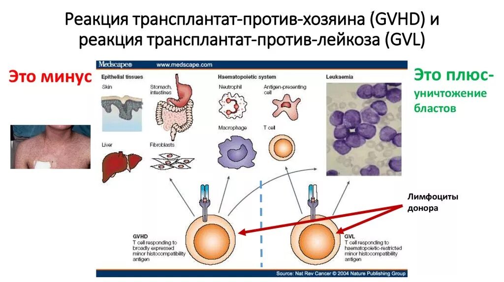 Трансплантант. Реакция трансплантат против хозяина иммунология. Реакция хозяин против трансплантата иммунология схема. Отторжение трансплантата Тип аллергической реакции. Механизм РТПХ иммунология.