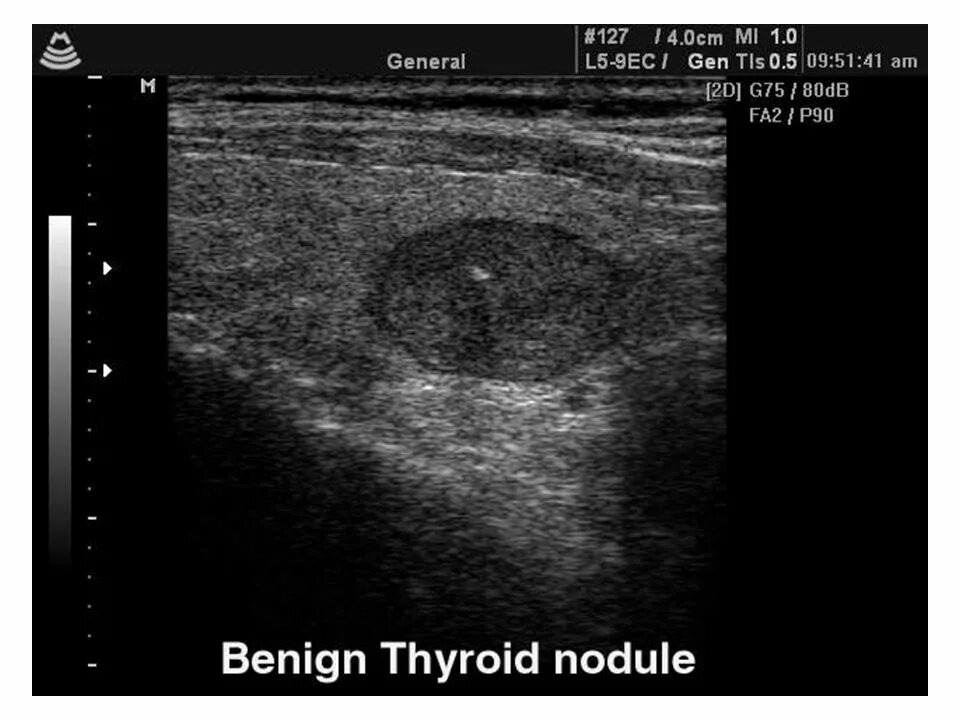 Эхограммы узлы щитовидной железы. Раковый узел в щитовидной железе УЗИ. Ультразвуковое исследование (УЗИ) щитовидной железы. Атлас УЗИ щитовидной железы. Киста щитовидной у мужчин