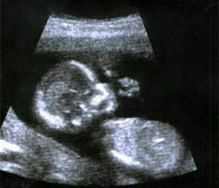 Малыш на 18 неделе беременности УЗИ. Ребёнок на 18 неделе беременности УЗИ. Снимки УЗИ на 18 неделе беременности. УЗИ мальчика малыша на 18 неделе беременности.