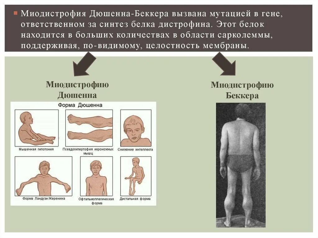 Миопатия беккера. Миодистрофия Беккера Тип наследования. Миодистрофия Дюшенна-Беккера Тип наследования. Синдром дистрофия Дюшенна.