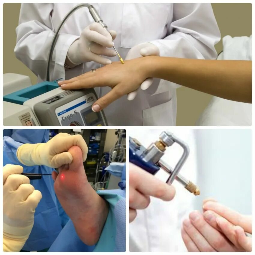 Криодеструкция шипицы. Криодеструкция папиллом. Химическое удаление бородавок. Бородавки лекарство ферезол. Криодеструкция вирусных бородавок.