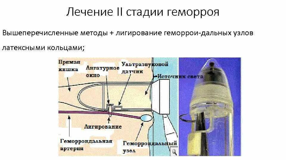 После лигирование геморроидальных узлов. Латексное лигирование узлов. Латексное лигирование геморроя. Лигирования геморроидальных узлов. Лигирование внутренних геморроидальных узлов.