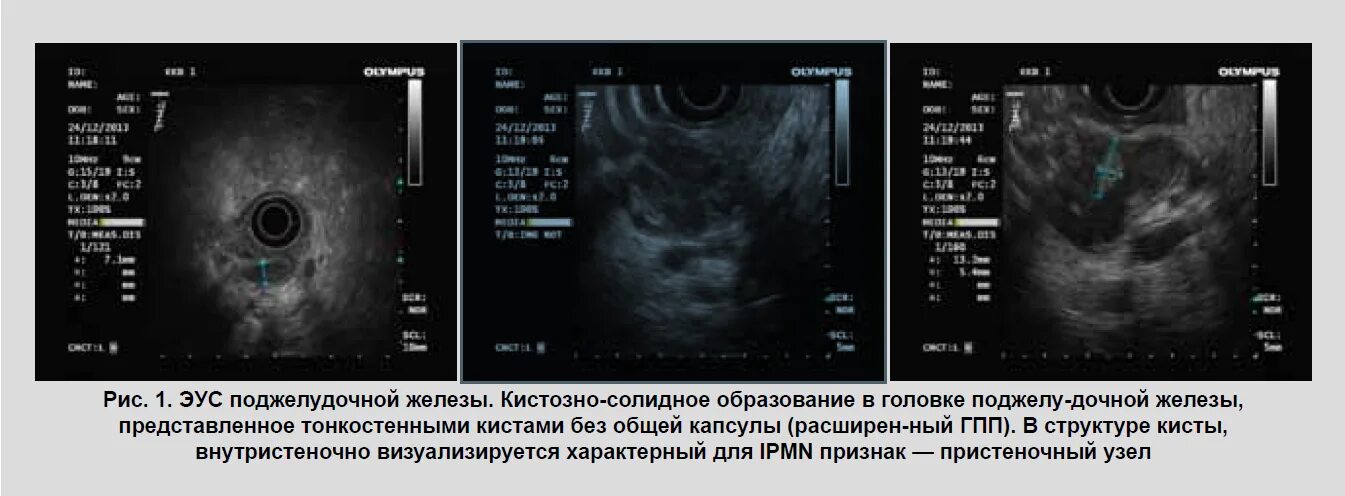 Кистозный солидный образование молочные железа. Солидные образования щитовидной железы на УЗИ. Кистозно-солидный узел щитовидной железы на УЗИ. Ультрасонография поджелудочной железы. Солидный узел щитовидной железы на УЗИ.