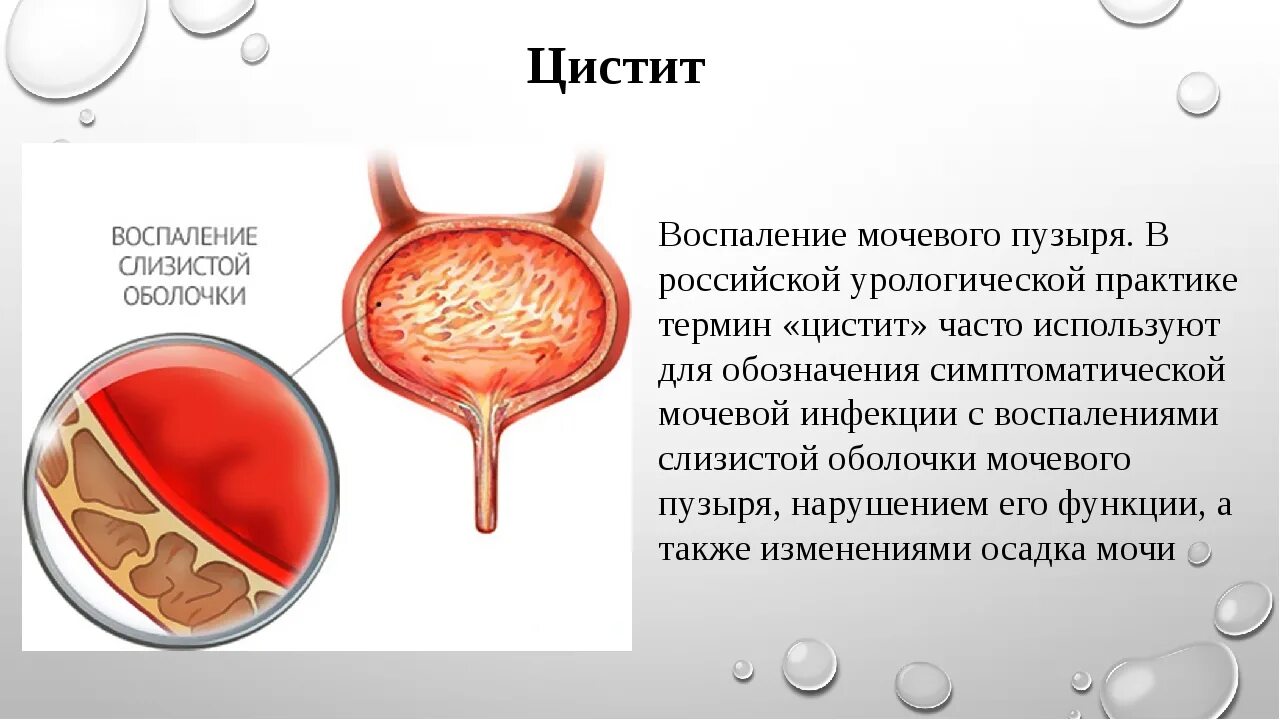 Рецидив цистита. Заболевания мочевого пузыря. При болезнях мочевого пузыря.