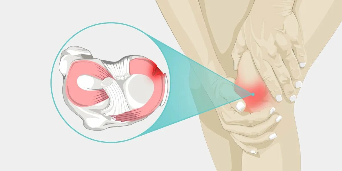 Болит ли мениск. Разрыв мениска коленного сустава 3 а. Мениски коленного сустава 3а.