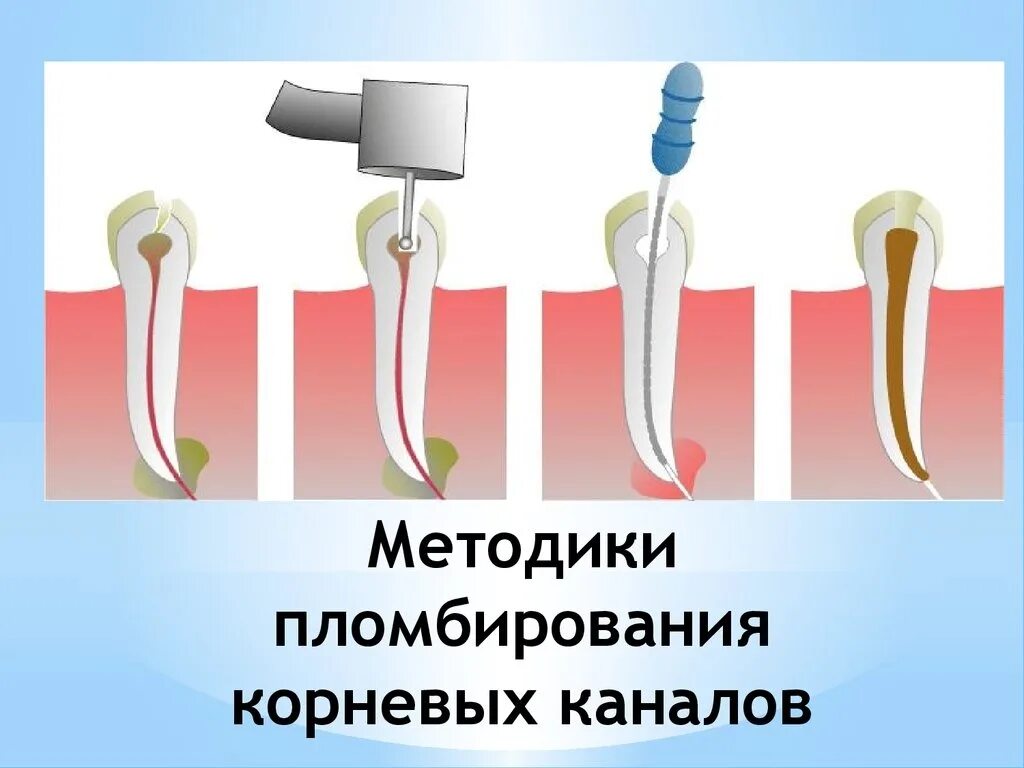 Временное пломбирование каналов зуба. Пломбировка корневых каналов. Пломбирование корневого канала зуба. Методы пломбирования каналов. Методики пломбирования корневых каналов.