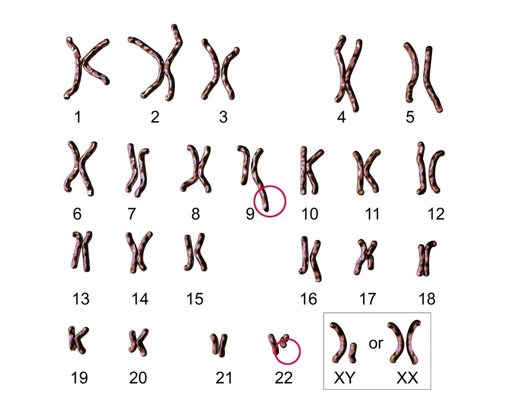 Синдром Дауна 21 хромосома. Синдром Дауна рисунок хромосом. 46,XY нормальный мужской кариотип. Синдром Патау кариотип. Синдром дауна лишняя хромосома