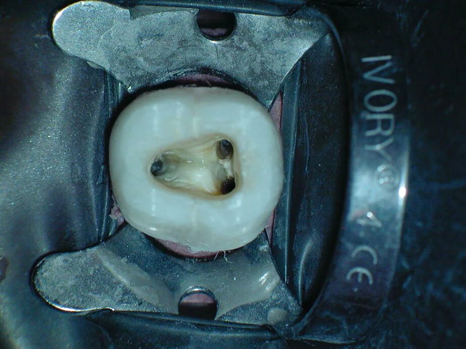 1 корневой канал. Вскрытая пульповая камера. Раскрытая полость зуба.
