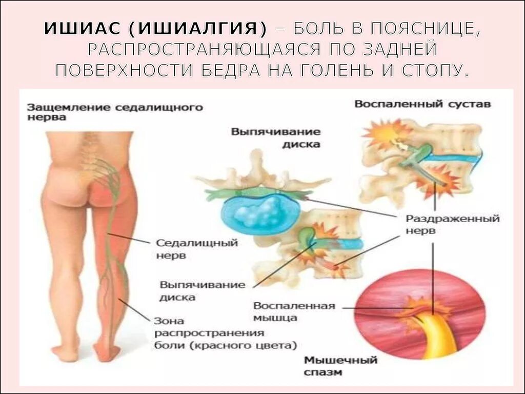 Боль в пояснице при вставании. Воспаление седалищного нерва. Воспаление и защемление седалищного нерва. Защемление седалищного нерва причины. Седалищный нерв симптомы и причины боли.