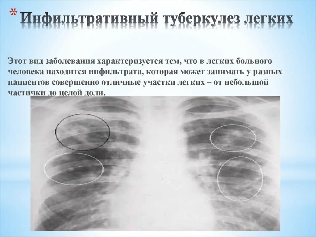 Инфильтративный туберкулез рентген. Очаговый туберкулез легких в фазе инфильтрации рентген. Очагово-инфильтративный туберкулез рентген. Инфильтративный туберкулез легкого с1-2.