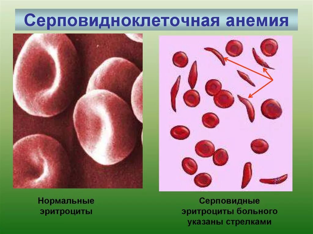 Серповидная анемия эритроциты. Серповидно клеточная анемия эритроциты. Серповидноклеточная анемия эритроциты форма. Серповидно-клеточная анемия (s-гемоглобинопатия). Серповидно клеточная анемия признаки