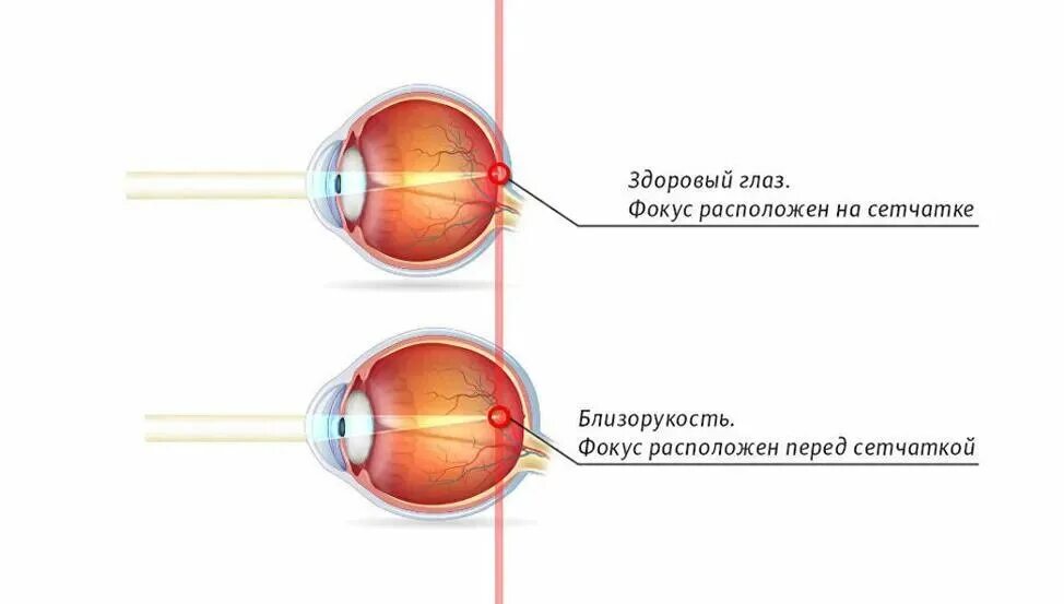 Близорукость и дальнозоркость глазное яблоко. Схема глазного яблока при близорукости. Глазное яблоко удлинённой формы близорукость дальнозоркость. При дальнозоркости глазное яблоко удлиненной формы. Перед сетчаткой расположена