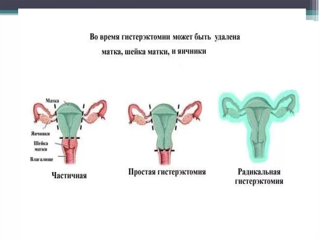 Сколько живут после удаления матки