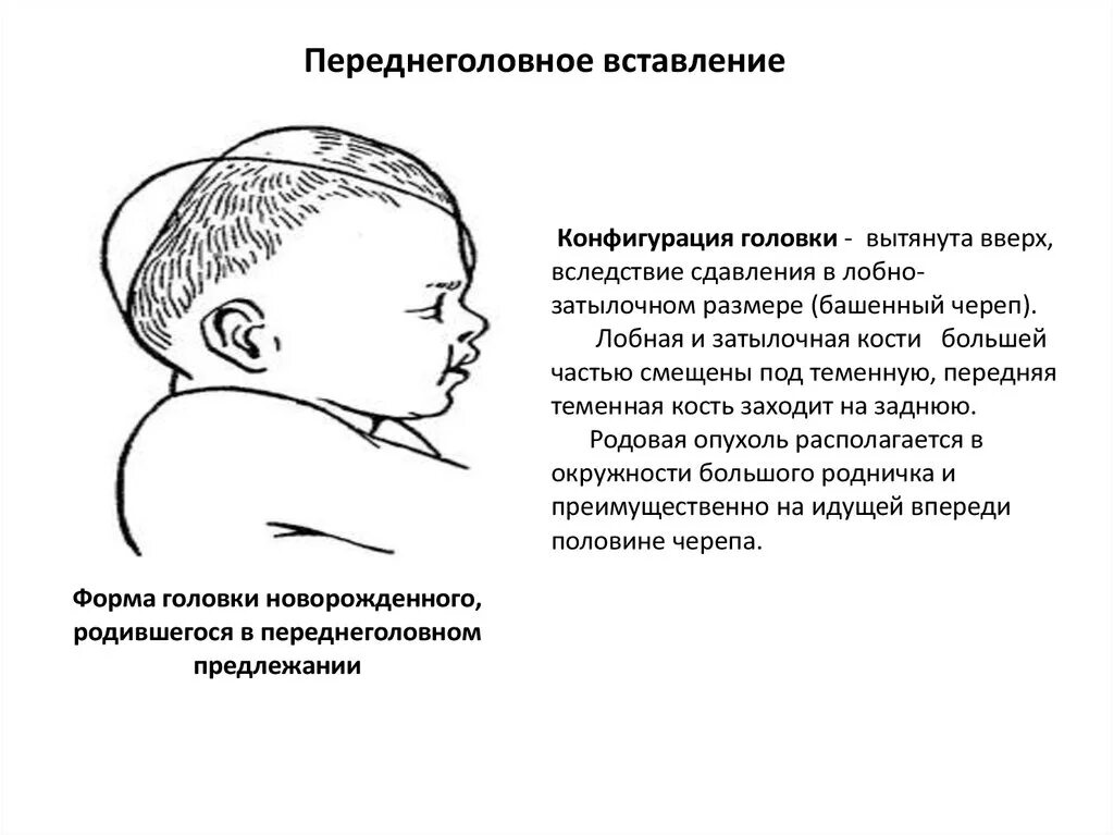 Форма головки новорожденного. Форма головы новорожденного. Форма головы новорожденного норма. Переднеголовном предлежании. Переднеголовное предлежание