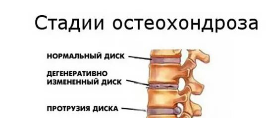 Остеохондроз гоп что это. Стадии остеохондроза. поясничный остеохондроз симптомы. остеохондроз грудного отдела позвоночника 2 ст. стадии остеохондроза поясничного отдела позвоночника.