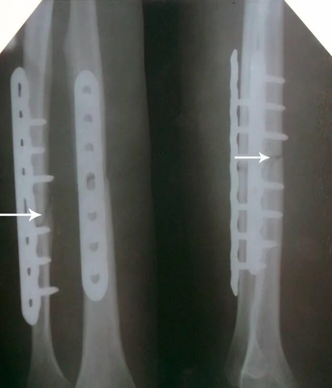 Почему болит кость после перелома. Остеосинтез пластиной консолидация. Срастание кости на рентгене. Костная мозоль после перелома на рентгене. Рентген костная мозоль пере.