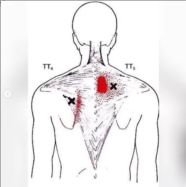 Триггерные точки поясницы. Триггерные точки в мышцах спины. Трапециевидная мышца спины триггерные точки. Триггерные точки на спине схема. Триггерные точки боль мышцы спины.