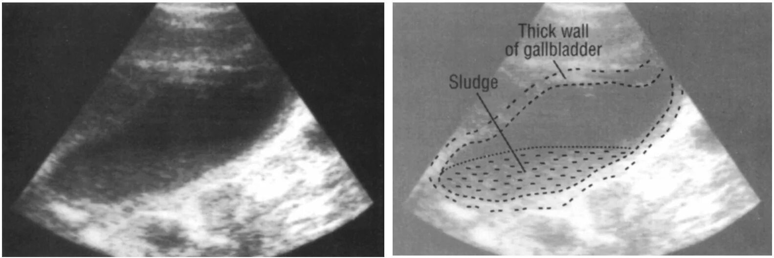 Утолщенная стенка желчного пузыря на УЗИ. Сладж в желчном пузыре УЗИ. Взвесь в желчном пузыре на УЗИ. Билиарный сладж в желчном пузыре. Эхо признаки желчного пузыря