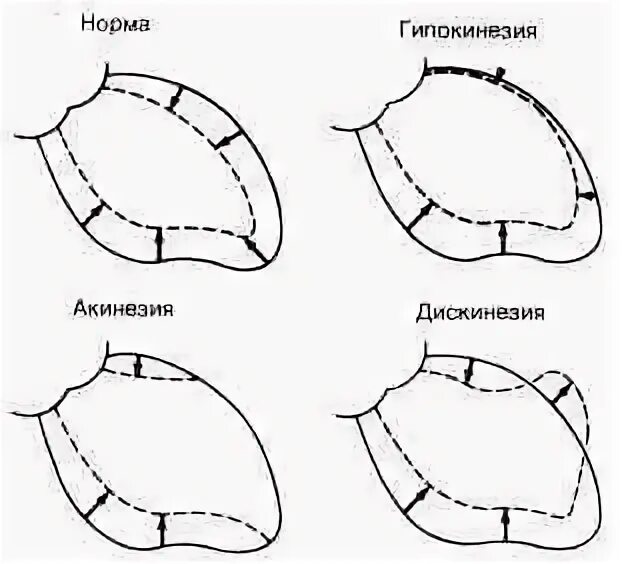 Гипокинез среднего сегмента. Гипокинез акинез миокарда. зоны гипокинеза. гипокинезия и акинезия. зоны акинезии на эхокг.