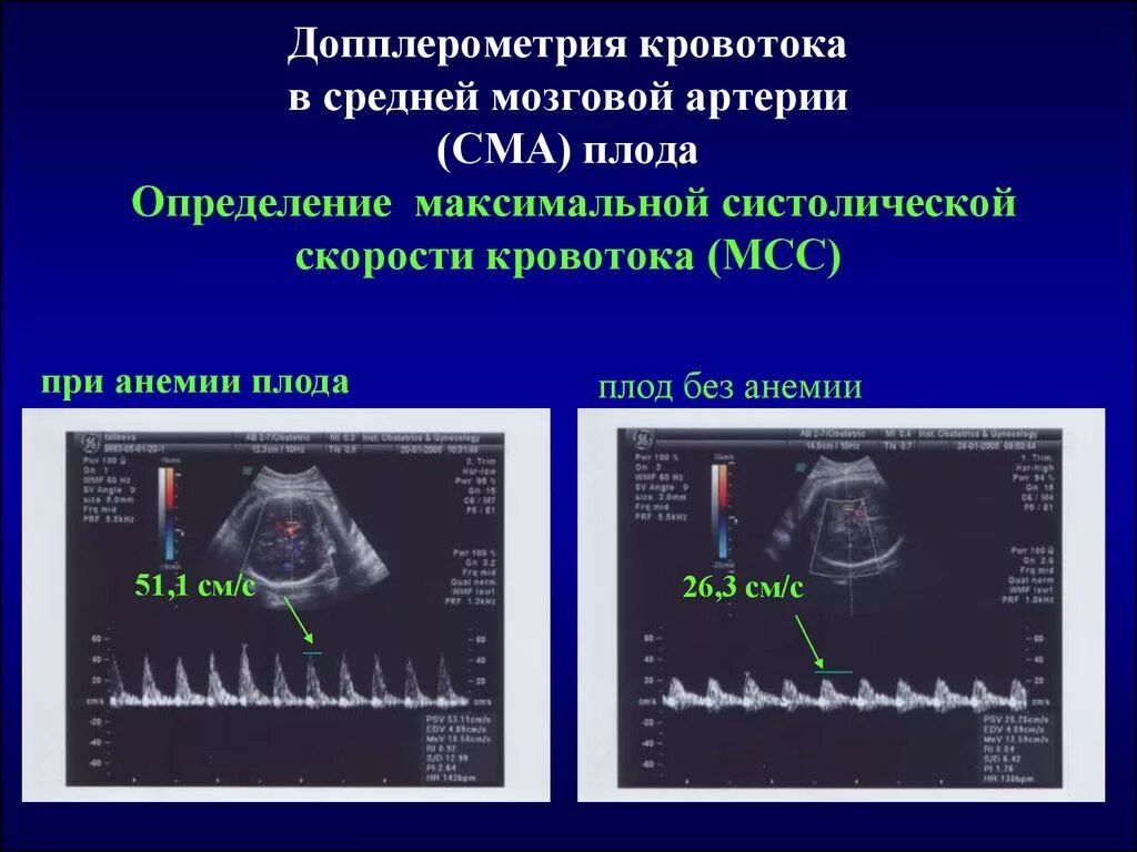 Средняя скорость кровотока в артерии. Скорость кровотока в капиллярах. Средняя скорость кровотока в артерии. Линейная скорость кровотока. Показатели кровотока в сма плода норма.