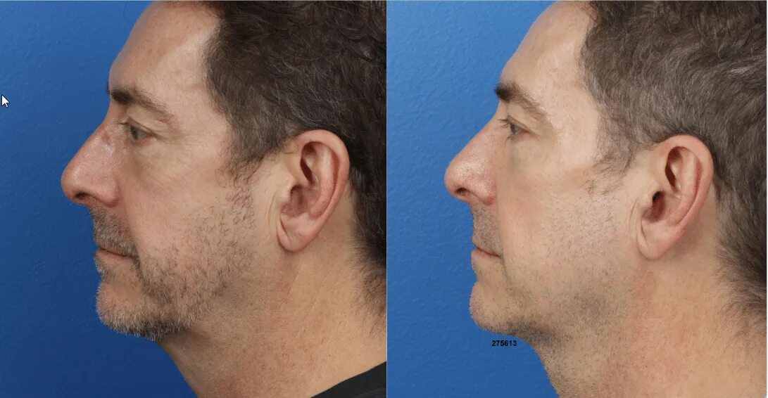 Jaw me. Defined jawline before. v jawline до после. jaw and chin contouring fillers.