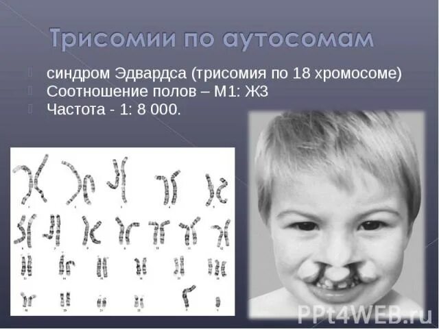 Пересадка хромосом. Трисомия по 18 хромосоме синдром Эдвардса. Синдром Эдвардса (трисомия в 18-Ой хромосоме).. Синдром Патау (трисомия 13-й хромосомы). Синдром трисомии по 8 хромосоме.