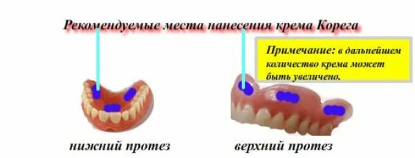 Как правильно наносить корегу на протез. Съемные зубные протезы на Кореге. Нанесение крема на протез. Как правильно наносить КОРЕГУ на верхний протез. Корега для зубных протезов.