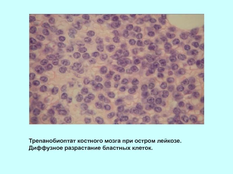 Мозг при остром лейкозе. Хронический миелолейкоз костный мозг микропрепарат. Острый миелолейкоз костный мозг. Трепанобиоптат костного мозга. Костный мозг при миелолейкозе микропрепарат.