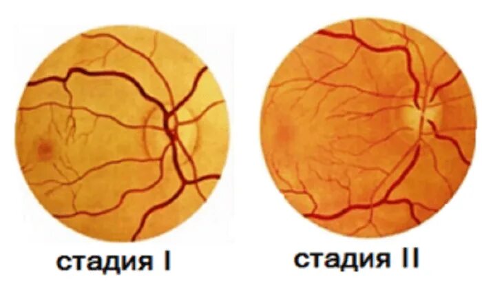Ангиопатия сетчатки глазное дно. Ангиопатия и ретинопатия сетчатки. Ангиопатия сосудов глаз. Сетчатки по гипертоническому типу