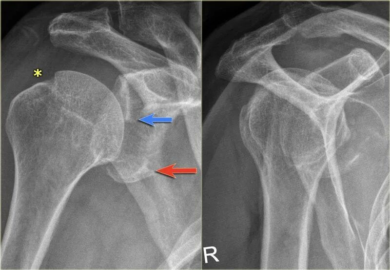 Травмы плечевого сустава рентген. Киста плечевого сустава рентген. Рентген исследования плечевого сустава.